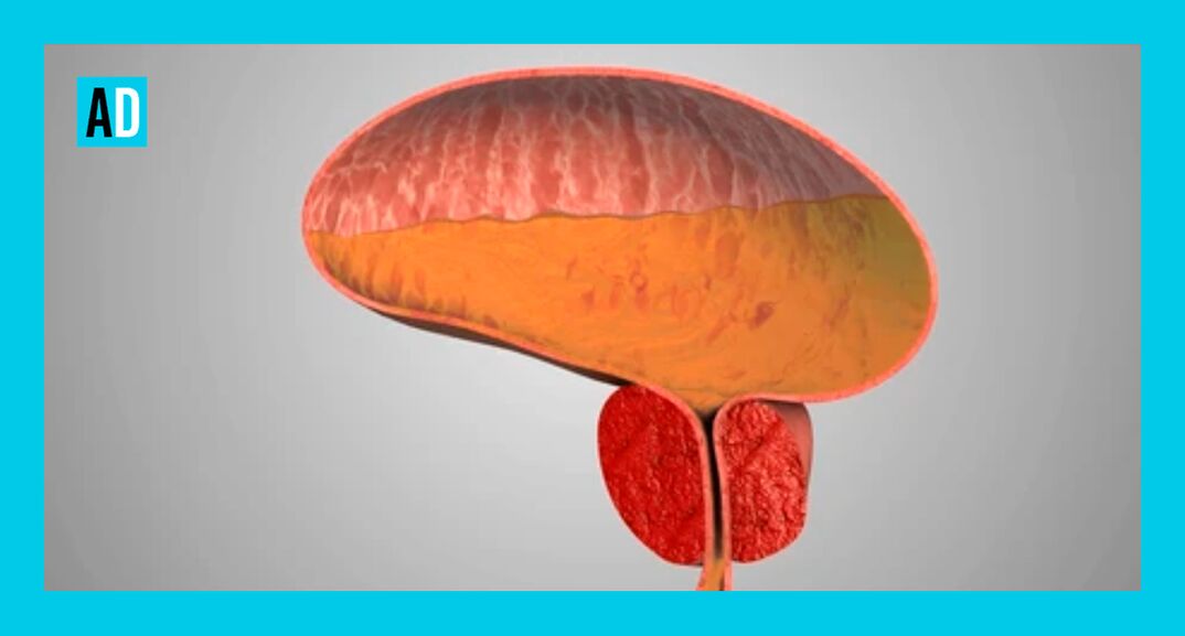 Põletikuline eesnääre